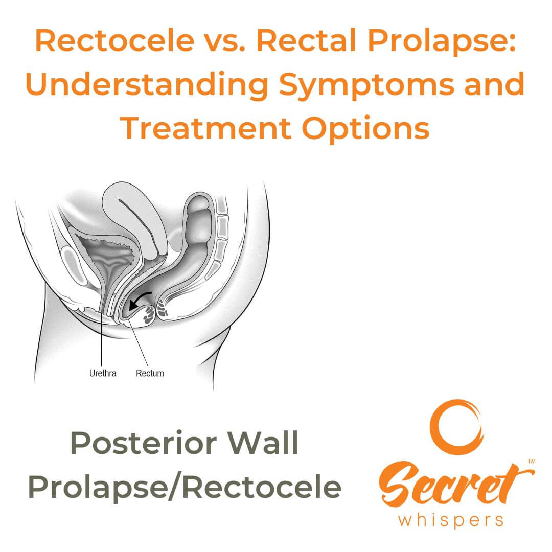 Rectocel Images Rectocele vs. Rectal Prolapse: Understanding Symptoms and Treatment ...