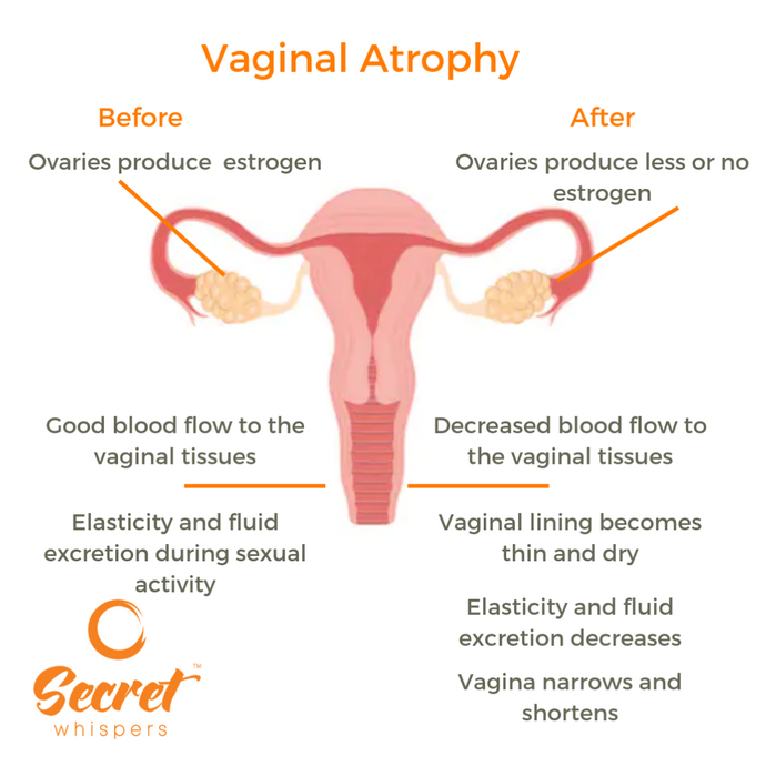 Vaginal Dryness - "It Feels Like Barbed Wire"