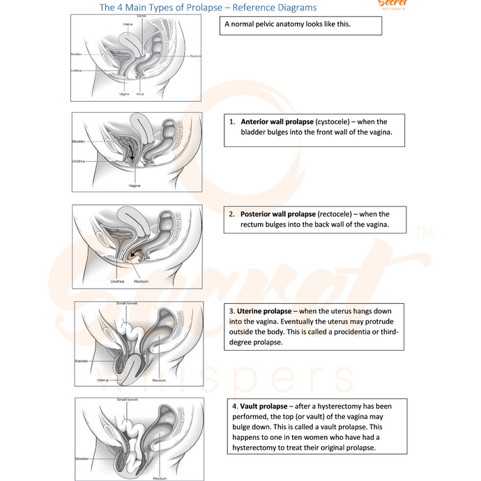 Have I got a prolapse? Signs and symptoms explained.